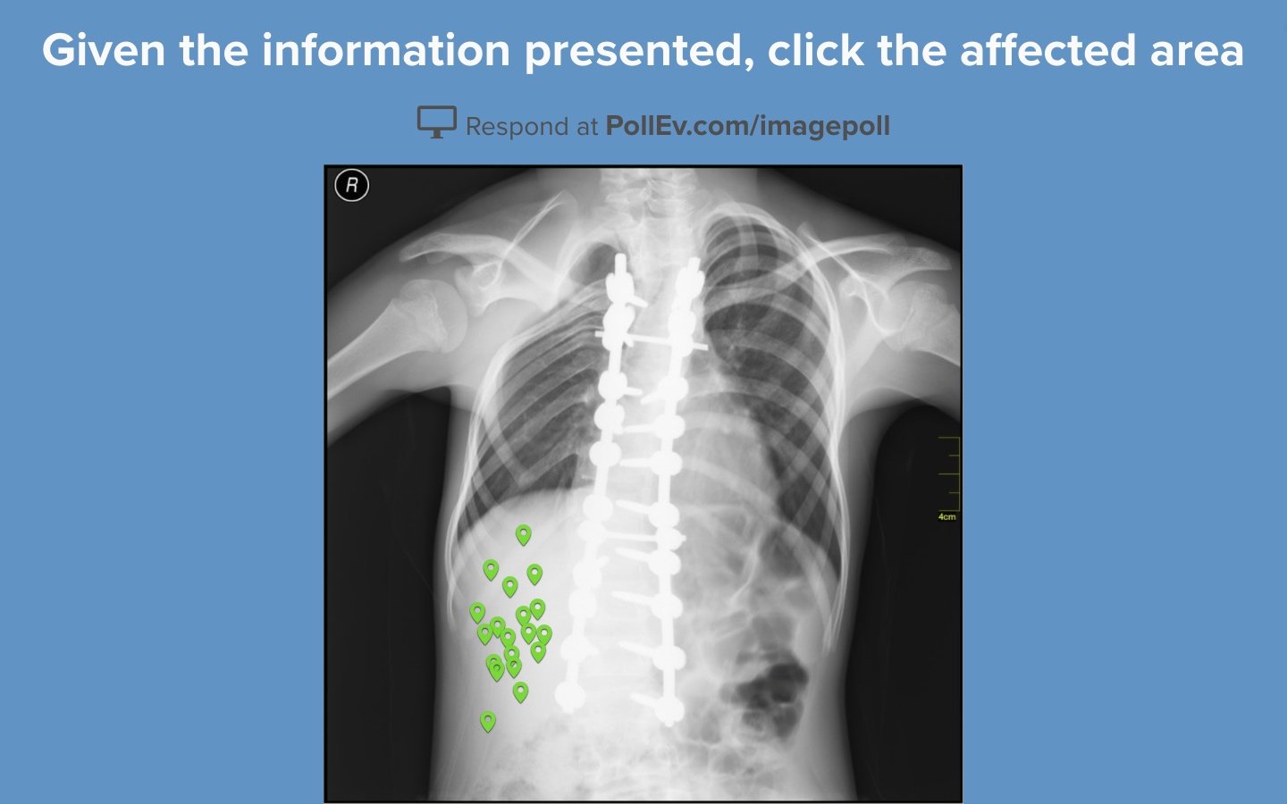 clickable-image-poll-x-ray